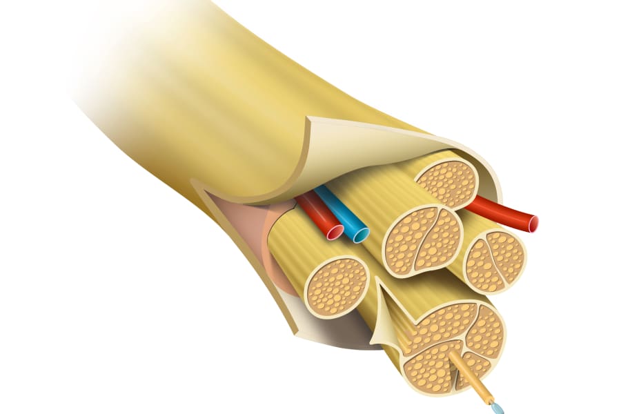 Perineural Injection Therapy (PI)